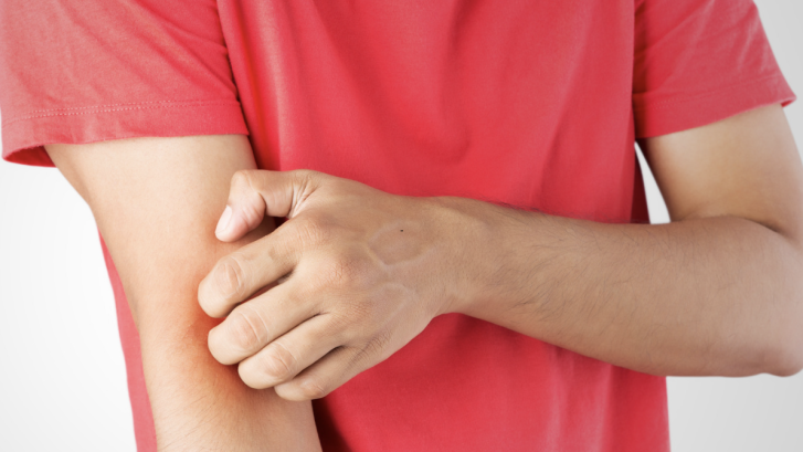 Psoriasis or Eczema Treatment Near North Beach MD